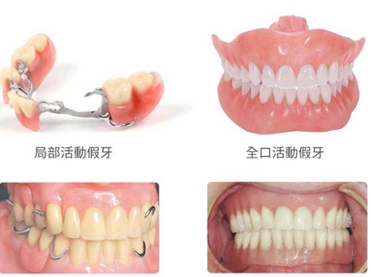 装一颗假牙要多少钱?除了假牙的材质,哪些因素还影响假牙价格?附各种假牙售价介绍~