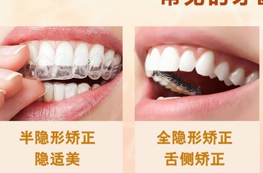 广州矫正牙齿多少钱?牙齿矫正有哪些方法?及时矫正,受益终生!