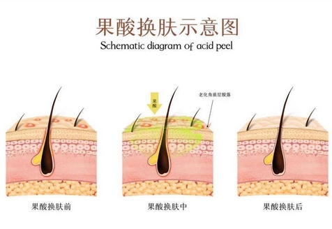 果酸换肤价格多少钱?哪些因素影响果酸换肤价格?医美小白get指南~