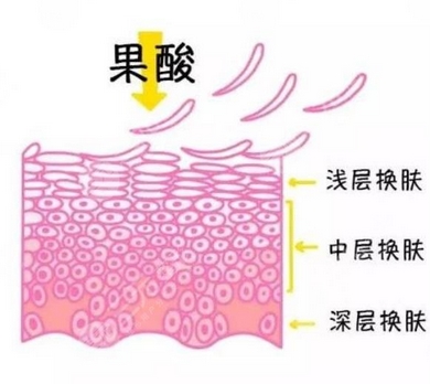 果酸换肤价格多少钱?哪些因素影响果酸换肤价格?医美小白get指南~