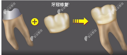 做牙冠的步骤是怎样的？这几个步骤告诉你是怎样种的牙齿！使用寿命是多久呢？