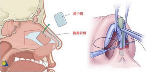杭州华山连天美做肋软骨隆鼻如何？本院实力详情、医生实力一览！附案例分享~