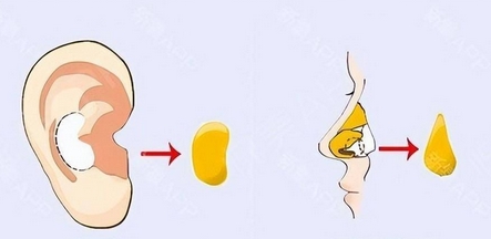 自体软骨隆鼻好不好？可以维持多久呢？隆鼻之后注意事项有哪些？