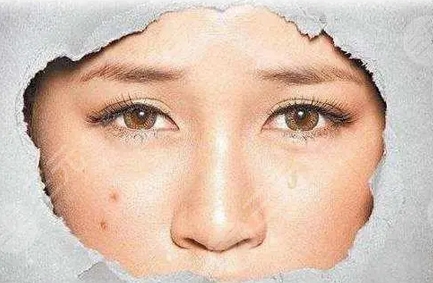 像素激光调节痘疤做几次?可以恢复到什么程度?需要多少钱?带你了解~