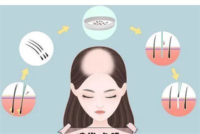 发际线后移能恢复吗?发际线后移受哪些因素影响?