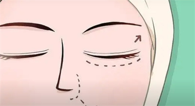 眼部整容手术有哪些?上睑下垂也能做重睑术吗?