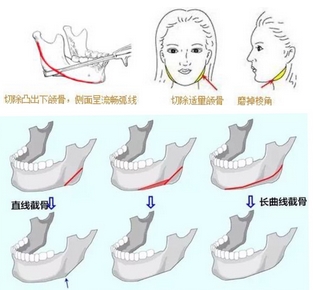 杭州华山高俊明下颌角磨骨手术怎么样?改脸型大咖实力送上!附真实案例~