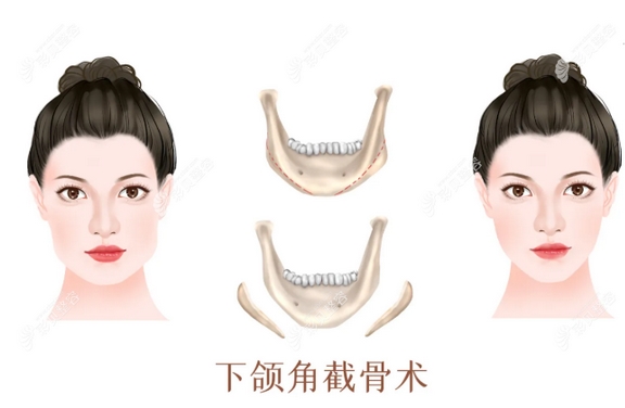 杭州华山高俊明下颌角磨骨手术怎么样?改脸型大咖实力送上!附真实案例~