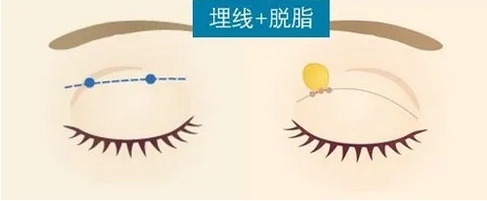 西南医院美容美容整形科双眼皮价格更新!重庆"网红"整形医生技术测评!附价格表~