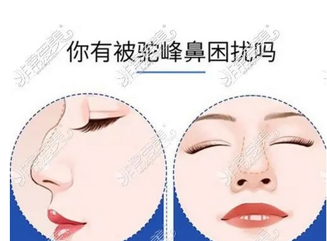驼峰鼻修复价格是什么？只处理鼻头就可以了吗？驼峰鼻如何修复呢/