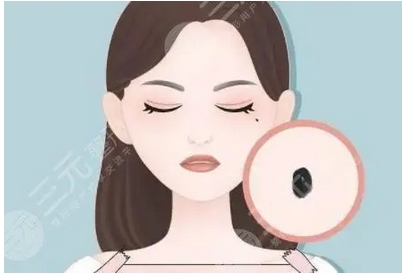 青医附院整形科激光点痣多少钱？价格清晰一览~有意向的小姐妹不要错过哦！