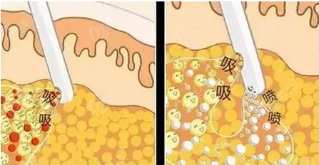 水动力吸脂和环吸哪个果好？有什么区别吗？注意事项有哪些？