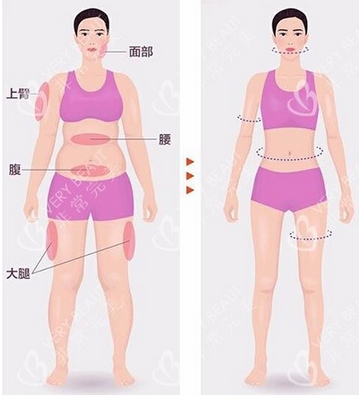 抽脂形体改良怎么做？多少钱一次？超全科普一篇解答你的疑问！