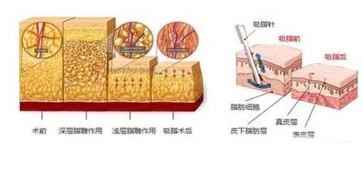 抽脂形体改良怎么做？多少钱一次？超全科普一篇解答你的疑问！