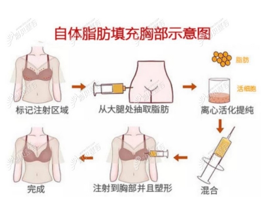 自己脂肪的隆胸手术多少钱?费用明细|手术过程介绍!注意事项出炉~