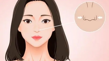 鼻头鼻翼缩小术价格是多少?手术是怎么操作的?助你告别“猪猪鼻”~