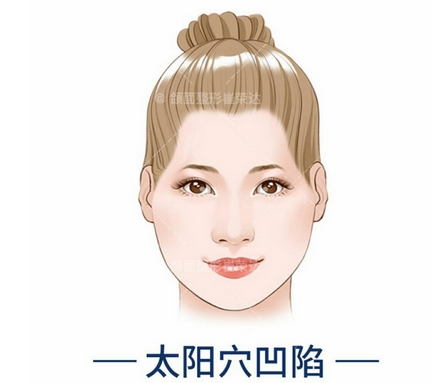 自体脂肪填充太阳穴案例公开！果好不好？看看近期案例展示~