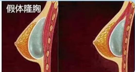 胡学庆做隆胸怎么样？真人做胸部整形过程来袭！价格可参考