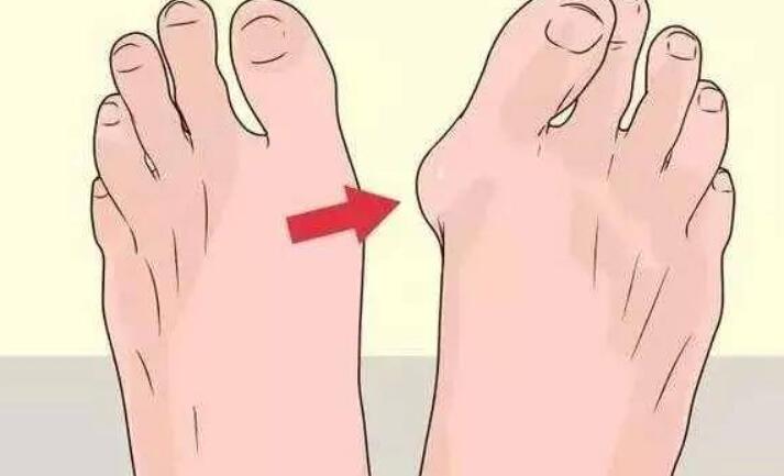 大脚骨怎么办?有什么调节方法?戳进来了解一下