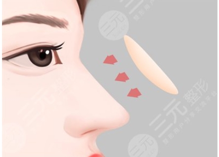 鼻翼缩小前后对比果怎么样?真实案例分析!给你带来颜值的蜕变~