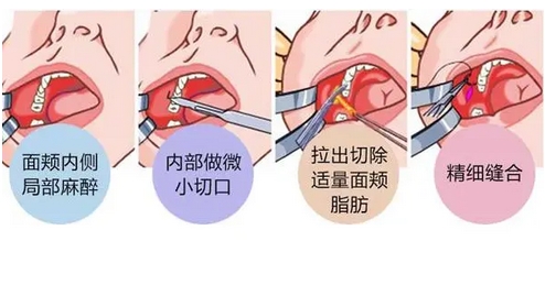 去颊脂垫恢复时间是多久？多久可以自然呢？超全科普搞定你的脸颊肉！