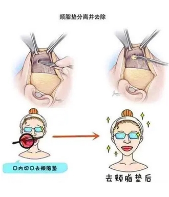 去颊脂垫恢复时间是多久？多久可以自然呢？超全科普搞定你的脸颊肉！