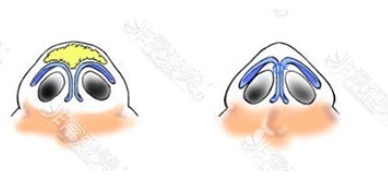 鼻翼肥大怎么办?鼻翼肥大手术需要多少钱?手术前后注意事项有哪些?