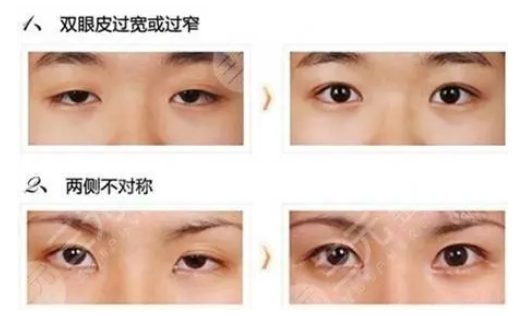 北大深圳医院整形科李天石双眼皮怎么样?医生|科室详细资料介绍!精选案例等你查看~
