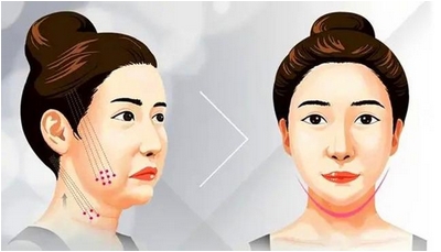 整瓜子脸需要多少钱?整瓜子脸是什么原理?提升魅力值~