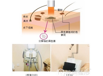 激光调节雀斑的价格怎么样?激光调节雀斑是什么原理呢?附注意事项分享~