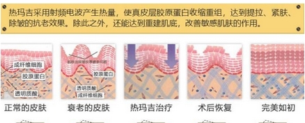 热玛吉紧肤多少钱?有哪些因素影响了费用?需要注意哪些看这里~