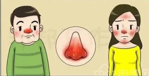 酒糟鼻整形术如何?看看酒糟鼻整形术有哪些?摆脱尴尬红鼻头~