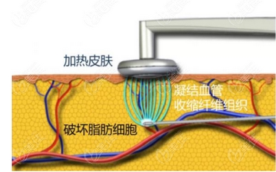 等离子光纤溶脂怎么样?果好不好?有没有副作用?附注意事项~