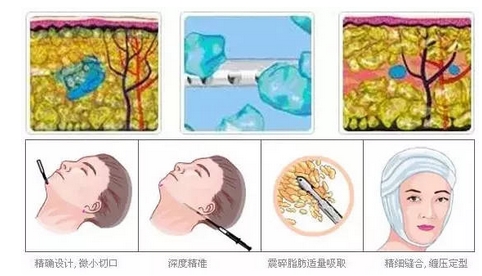 等离子光纤溶脂怎么样?果好不好?有没有副作用?附注意事项~