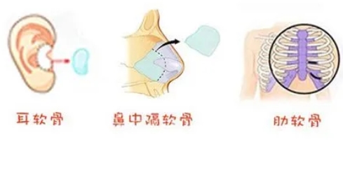 自体软骨隆鼻果如何?自体软骨隆鼻什么原理呢?详细手术过程带你了解~