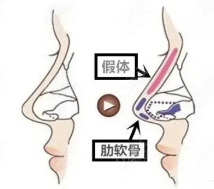 肋骨鼻三个月了还会感染吗?细数肋骨鼻的原理及特色!带你详细了解~