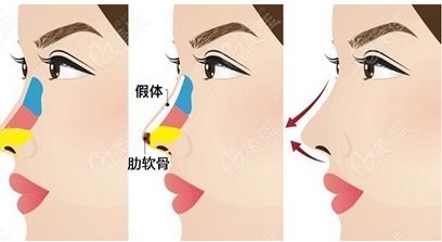 肋骨鼻三个月了还会感染吗?细数肋骨鼻的原理及特色!带你详细了解~