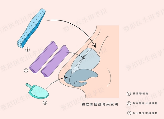 肋骨鼻三个月了还会感染吗?细数肋骨鼻的原理及特色!带你详细了解~