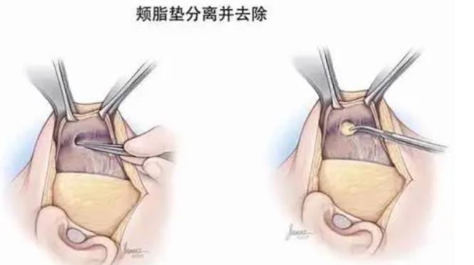 去颊脂垫多久能恢复？有什么优势？术后如何护理呢？