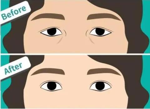 上眼皮松弛矫正方法是怎样的？矫正的方法有什么优势？
