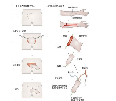 变性手术全过程是什么？揭密变性手术需要经历哪些？需要注意这些~