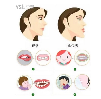调节牙齿地包天的方法是什么？矫正需要多长时间？矫正优点有哪些~