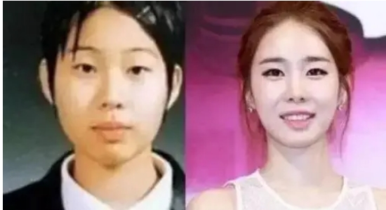 刘仁娜整容前是什么样子的呢?整容痕迹明显却不妨碍美!展现自我魅力~