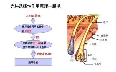 半导体激光脱毛如何?看看脱毛方式有哪些?附注意事项汇总!