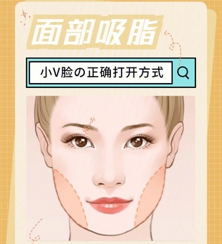 面部吸脂和去颊脂垫哪个好?分别用了什么原理?优势劣势公开分析~