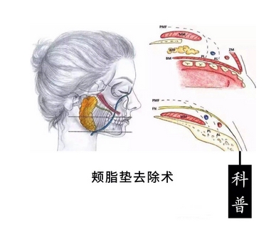 面部吸脂和去颊脂垫哪个好?分别用了什么原理?优势劣势公开分析~