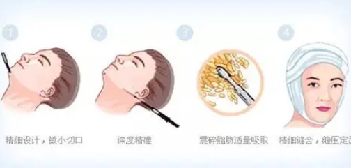 面部吸脂和去颊脂垫哪个好?分别用了什么原理?优势劣势公开分析~