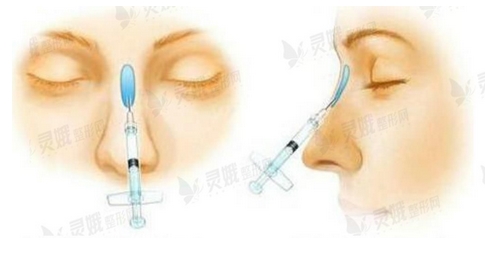 胶原蛋白隆鼻好吗?可以维持多久呢?是什么原理呢?注意事项汇总参考~