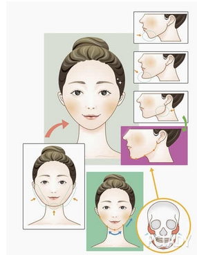 女人过大下颌角整形如何?价格贵不贵?看看费用与哪些因素有关呢?