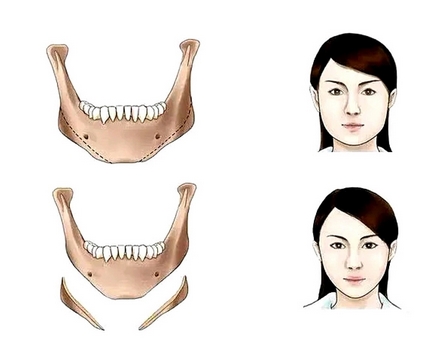 女人过大下颌角整形如何?价格贵不贵?看看费用与哪些因素有关呢?